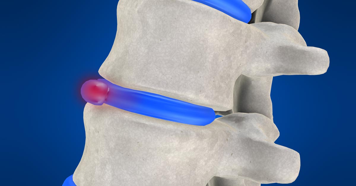 Spinal decompression therapy in Hauppauge, Long Island